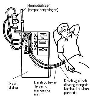 Gambar 2. Proses Hemodialisa 5.2 Pembahasan Pasien masuk ke Rumah Sakit Umum Daerah Dr. Pirngadi Kota Medan pada tanggal 16 Agustus 2009 jam 10.