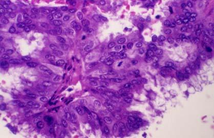 activity 3 Papillary carcinoma forming complex papillary