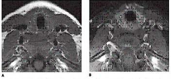 Gambar 4 : a.gambaran CT Scan kelenjar tiroid sebelum diberikan gadolinium dan b.