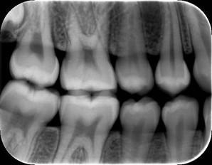 11 Radiografi periapikal memiliki beberapa kegunaan, yaitu untuk mendeteksi infeksi atau inflamasi periapikal, penilaian status periodontal, trauma yang melibatkan gigi dan tulang alveolar, gigi yang