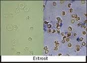 Gambar 1.Sel Eritrosit pada Sedimen Urin Gambar 2.Sel Lekosit pada Sedimen Urin b.