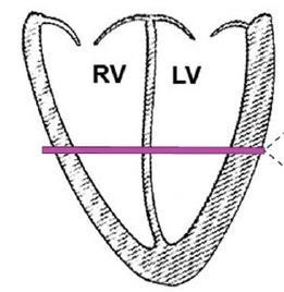 45 3 mm Keterangan: : Perbatasan Atrium dan ventrikel : Pemotongan untuk pengamatan arteri koronaria Gambar 14. Prosedur Pengambilan Bagian Arteri Koronaria (Eckman et al., 2013) 7.