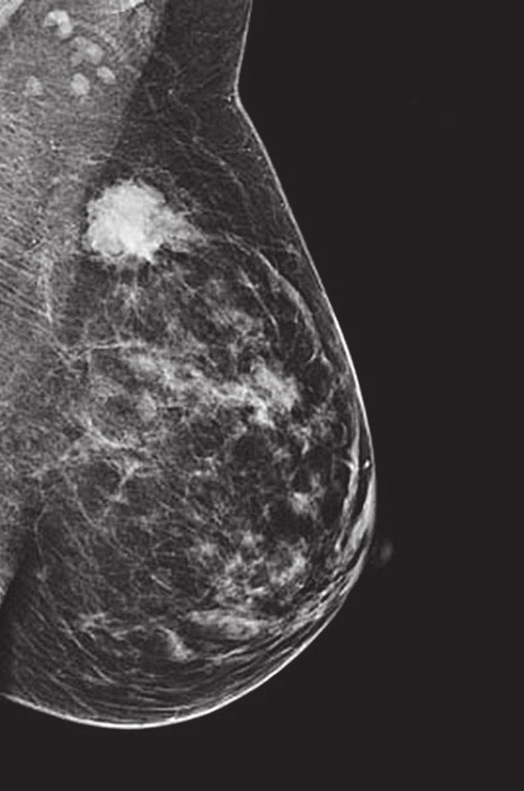 PERSEDIAAN SEBELUM MENJALANI PEMERIKSAAN MAMOGRAM Pada hari pemeriksaan mamogram, jangan guna bedak talkum, krim, minyak wangi atau deodoran pada bahagian dada dan ketiak.
