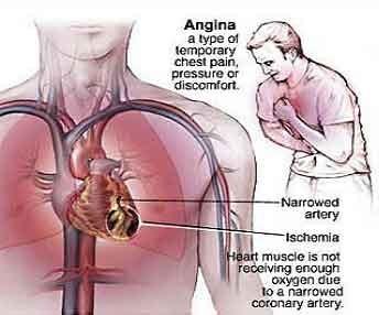 Askep angina pektoris
