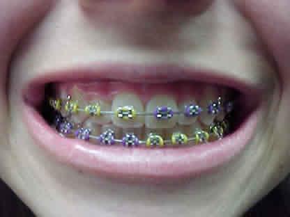 7 Gambar 1. Pengguna piranti ortodonti cekat. 13 2.3 Sikat Gigi Konvensional Sikat gigi konvensional merupakan sikat gigi yang dipakai dalam kehidupan sehari-hari.