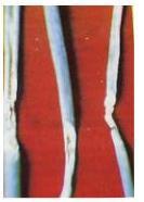 Gambar Gejala serangan penyakit Colletotrichum gloeosporioides pada tanaman bawang merah 5. Bercak Ungu Patogen: cendawan Alternaria porri (Ell.) Cif.