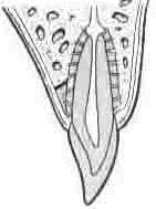 2. Fracture of the alveolar