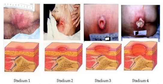 9 b. Tahap II Hilangnya sebagian ketebalan kulit meliputi epidermis dan atau dermis, ulkus superfisial dan secara klinis terlihat seperti abrasi lecet atau lubang yang dangkal. c.