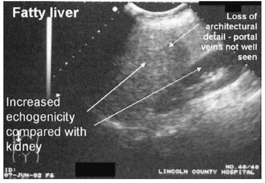36 2. Variabel terikat: gambaran fatty liver pada USG abdomen Pada ultrasonografi, infiltrasi lemak di hati akan menghasilkan peningkatan difus ekogenisitas (hiperekoik, bright liver, area berwarna