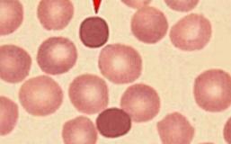 Gambar 1.3 Sferosit 4. Anisositosis : banyak diantara sel eritrosit lebih banyak bervariasi dalam ukurannya daripada keadaan normal.