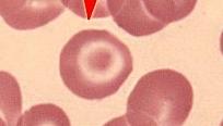 10 6. Leptosit : disebut juga sel target karena dibagian tengah eritrosit yang pucat terdapat lingkaran berwarna merah dipusat eritrosit. Gambar 2.6 Leptosit 7.