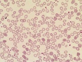 11 Gambar 3.1 Hipokrom 2. Polikromasia : mengikat zat warna asam sehingga disamping warna merah ada kebiru-biruan. Pematangan sitoplasma lebih lambat dibandingkan pematangan inti.