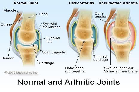nard u liječenju artritisa)