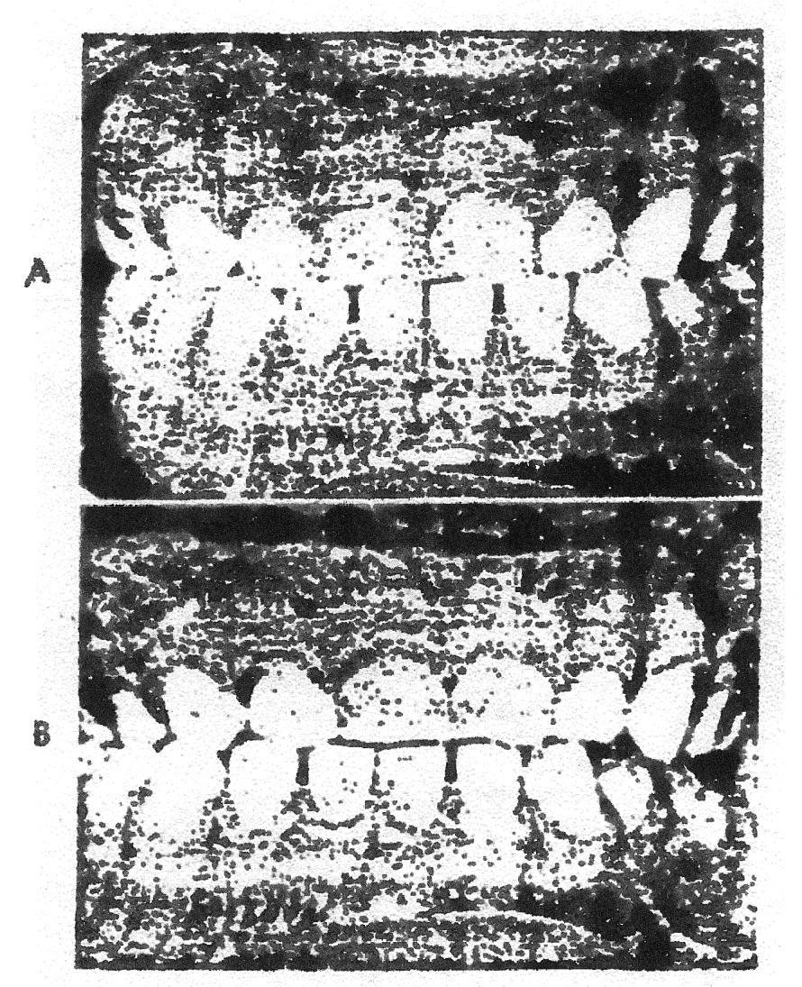 b. Pergerakan Mandibula ke lateral Dorongan erupsi gigi caninus permanen kadang menyebabkan gigi caninus decidui extrusi sehingga terjadi traumatik oklusi gigi caninus akibatnya mandibula akan