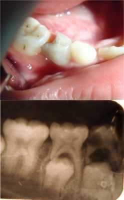 PENDAHULUAN Gigi sulung yang mengalami tanggal dini merupakan hal yang sering terjadi pada anak-anak baik akibat trauma maupun lesi karies luas sehingga gigi tersebut tidak dapat dipertahankan lagi.