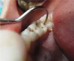 Selanjutnya dilakukan anestesi lokal untuk persiapan preparasi gigi 85 yang digunakan sebagai abutment (Gambar 3).