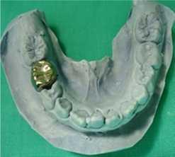 sempurna gigi yang telah dipreparasi (Gambar 8). Sebelum dilakukan sementasi, terlebih dahulu dilakukan pencetakan akhir dengan posisi crown berada di dalam rongga mulut.
