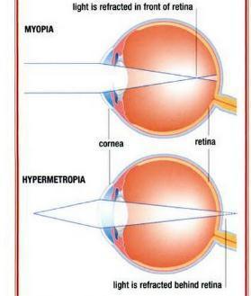 a operat miopia viziune stânga minus dreapta plus