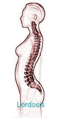 Kifosis adalah kelainan tulang karena sikap duduk membungkuk sehingga tulang belakang melengkung ke arah