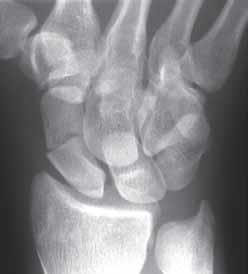 blocarea medicației articulațiilor umărului dureri articulare la degete