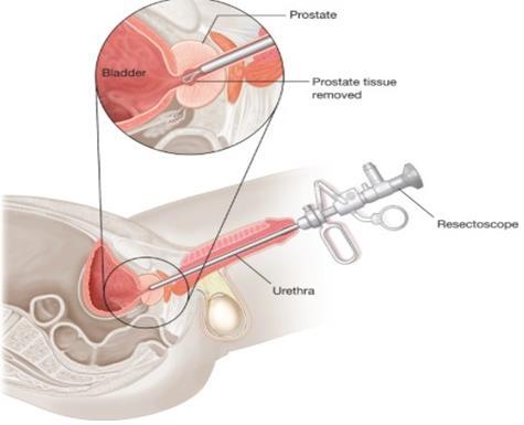 A prostatitis a vese sérülhet)