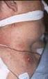 Traumatic or atraumatic brachial plexus diasease (e.g. parsonage-turner [acute brachial neuritis])