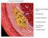 Analisis Aliran Darah dalam Stenosis Arteri Menggunakan Model Fluida Casson dan Power-Law
