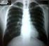 Saat. penyakit paling. atau. COPD/ Indonesia 1