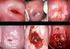Human Papilloma Virus Dan Kanker Serviks