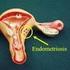 Pengertian. Endometriosis