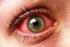manusia diantaranya penyakit mata konjungtivitis, keratitis, dan glaukoma.