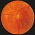 Hubungan antara tajam penglihatan dengan derajat non-proliferative diabetic retinopathy pada pasien diabetes melitus tipe 2